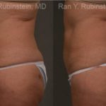 Coolsculpting Elite Before and After Photos in Montvale, NJ, Patient 12484