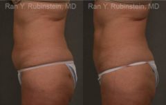 Coolsculpting Elite Before and After Photos in Montvale, NJ, Patient 12484