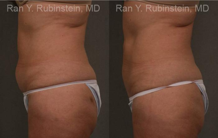 Coolsculpting Elite Before and After Photos in Montvale, NJ, Patient 12484