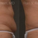Coolsculpting Elite Before and After Photos in Montvale, NJ, Patient 12487