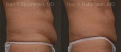 Coolsculpting Elite Before and After Photos in Montvale, NJ, Patient 12487