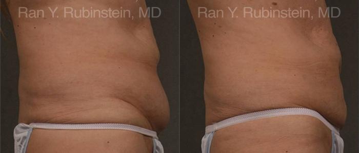 Coolsculpting Elite Before and After Photos in Montvale, NJ, Patient 12487