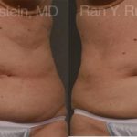 Coolsculpting Elite Before and After Photos in Montvale, NJ, Patient 12487