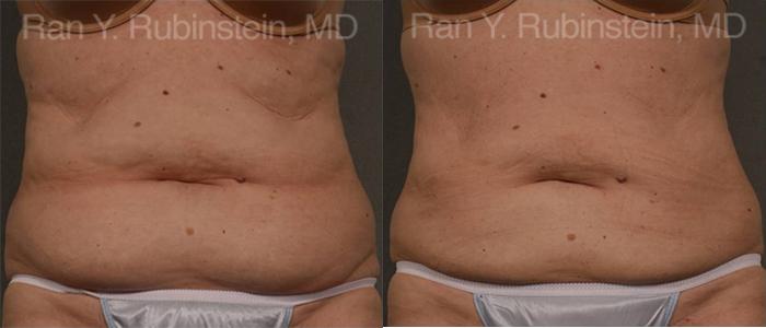 Coolsculpting Elite Before and After Photos in Montvale, NJ, Patient 12487