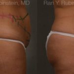 Coolsculpting Elite Before and After Photos in Montvale, NJ, Patient 12492