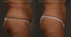 Coolsculpting Elite Before and After Photos in Montvale, NJ, Patient 12492