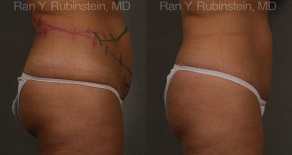 Coolsculpting Elite Before and After Photos in Montvale, NJ, Patient 12492