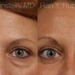 Eyelid Surgery Before and After Photos in Montvale, NJ, Patient 12591