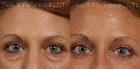Eyelid Surgery Before and After Photos in Montvale, NJ, Patient 12591