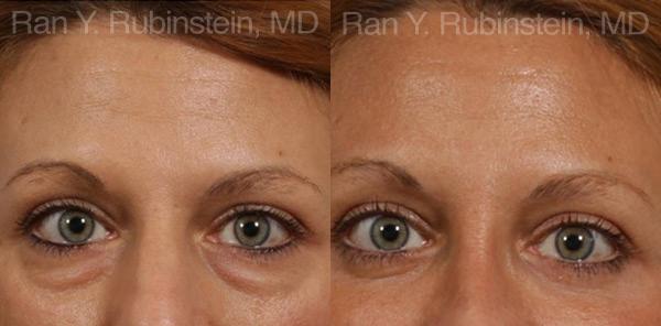 Eyelid Surgery Before and After Photos in Montvale, NJ, Patient 12591