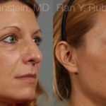 Eyelid Surgery Before and After Photos in Montvale, NJ, Patient 12591