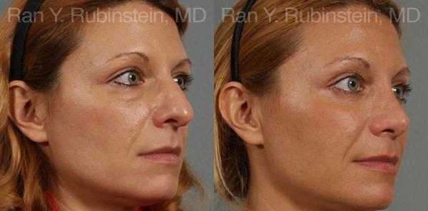 Eyelid Surgery Before and After Photos in Montvale, NJ, Patient 12591