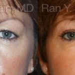 Eyelid Surgery Before and After Photos in Montvale, NJ, Patient 12616