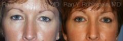 Eyelid Surgery Before and After Photos in Montvale, NJ, Patient 12616
