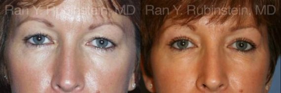Eyelid Surgery Before and After Photos in Montvale, NJ, Patient 12616