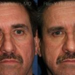 Fat Transfer Before and After Photos in Montvale, NJ, Patient 12694