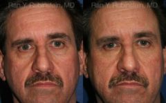 Fat Transfer Before and After Photos in Montvale, NJ, Patient 12694