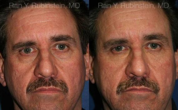 Fat Transfer Before and After Photos in Montvale, NJ, Patient 12694