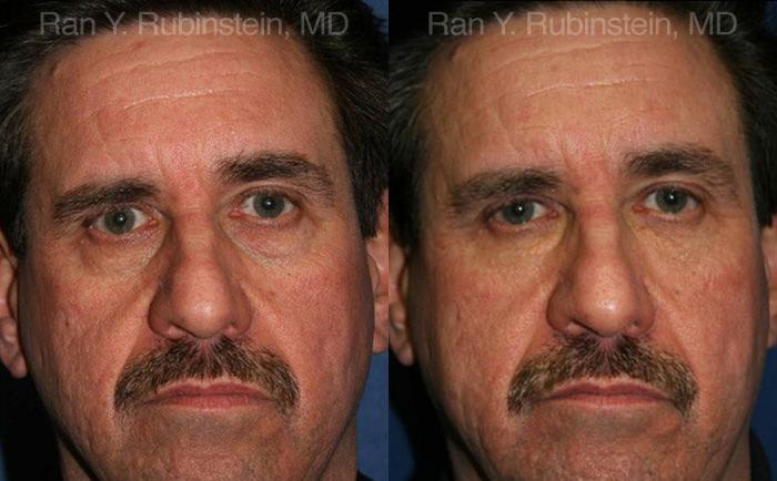 Fat Transfer Before and After Photos in Montvale, NJ, Patient 12694