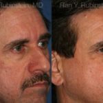 Fat Transfer Before and After Photos in Montvale, NJ, Patient 12694