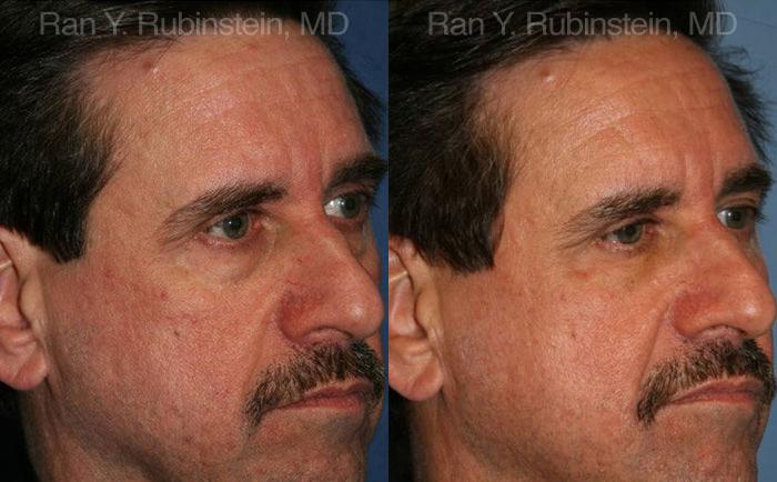 Fat Transfer Before and After Photos in Montvale, NJ, Patient 12694