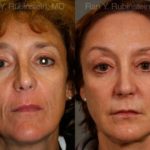 Sculptra Face Before and After Photos in Montvale, NJ, Patient 12699