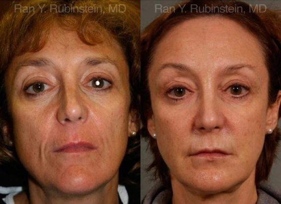 Sculptra Face Before and After Photos in Montvale, NJ, Patient 12699