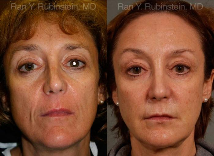Sculptra Face Before and After Photos in Montvale, NJ, Patient 12699