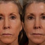 Dermal Fillers Before and After Photos in Montvale, NJ, Patient 12702