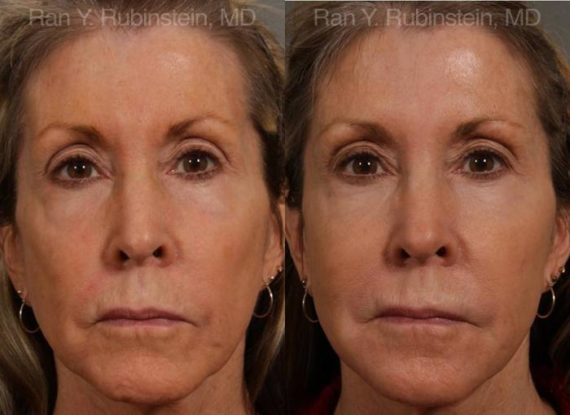 Dermal Fillers Before and After Photos in Montvale, NJ, Patient 12702