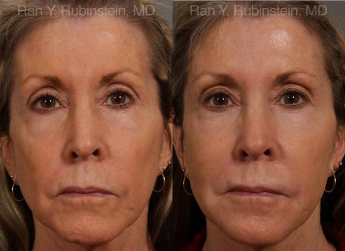 Dermal Fillers Before and After Photos in Montvale, NJ, Patient 12702