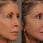 Dermal Fillers Before and After Photos in Montvale, NJ, Patient 12702