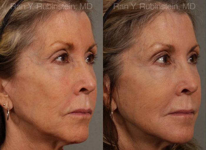 Dermal Fillers Before and After Photos in Montvale, NJ, Patient 12702