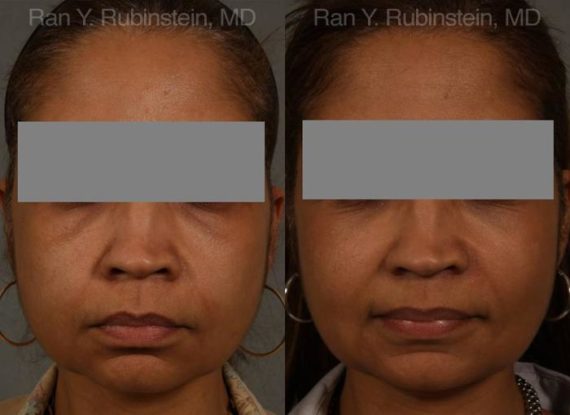 Dermal Fillers Before and After Photos in Montvale, NJ, Patient 12707