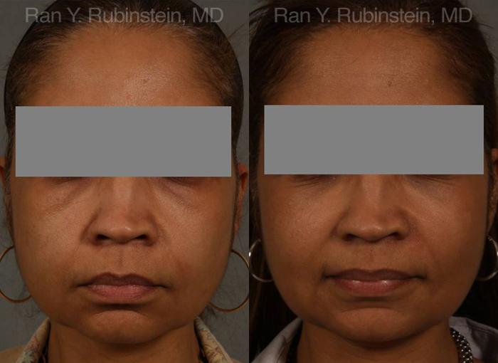 Dermal Fillers Before and After Photos in Montvale, NJ, Patient 12707