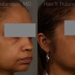 Dermal Fillers Before and After Photos in Montvale, NJ, Patient 12707