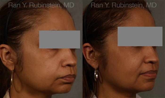 Dermal Fillers Before and After Photos in Montvale, NJ, Patient 12707