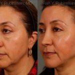Sculptra Face Before and After Photos in Montvale, NJ, Patient 12712