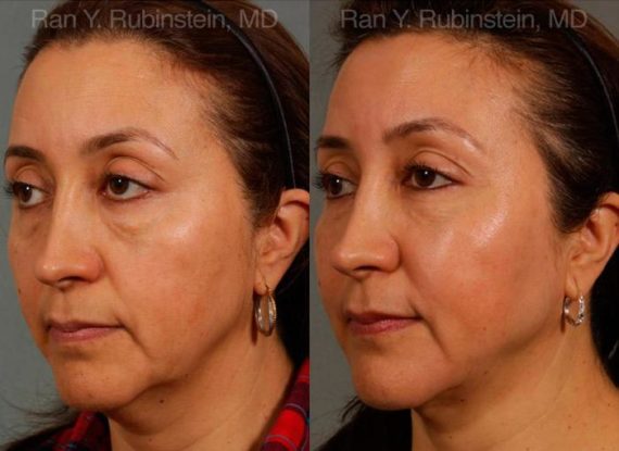 Sculptra Face Before and After Photos in Montvale, NJ, Patient 12712