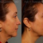Sculptra Face Before and After Photos in Montvale, NJ, Patient 12712
