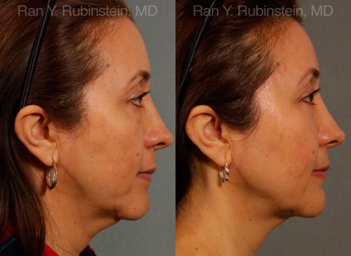 Sculptra Face Before and After Photos in Montvale, NJ, Patient 12712