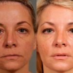 Dermal Fillers Before and After Photos in Montvale, NJ, Patient 12722