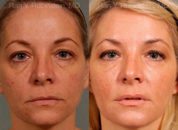 Dermal Fillers Before and After Photos in Montvale, NJ, Patient 12722