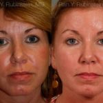 Dermal Fillers Before and After Photos in Montvale, NJ, Patient 12728