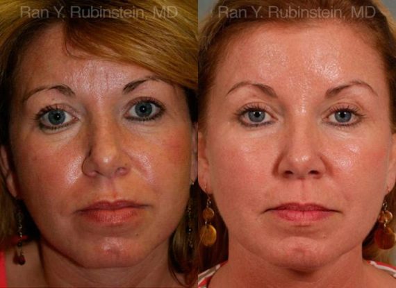 Dermal Fillers Before and After Photos in Montvale, NJ, Patient 12728