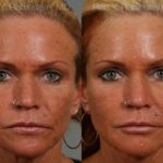 Dermal Fillers Before and After Photos in Montvale, NJ, Patient 12731