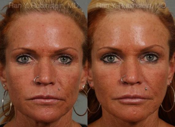 Dermal Fillers Before and After Photos in Montvale, NJ, Patient 12731
