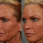 Dermal Fillers Before and After Photos in Montvale, NJ, Patient 12731