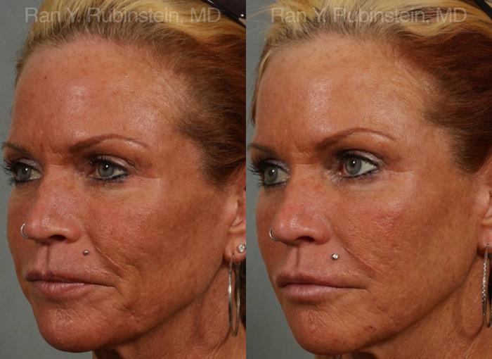 Dermal Fillers Before and After Photos in Montvale, NJ, Patient 12731