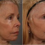 Dermal Fillers Before and After Photos in Montvale, NJ, Patient 12739